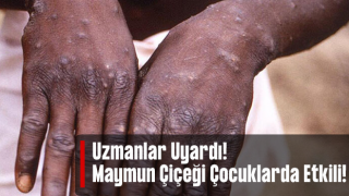 Uzmanı uyardı: Maymun çiçeği çocuklarda daha ciddi seyredebilir